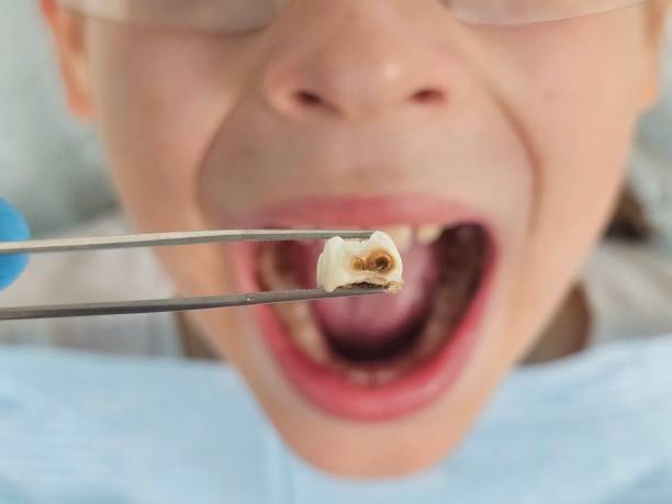 Best Emergency Root Canal Treatment in Mount Carmel, TN